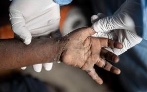 Mpox Cases Amidst Displacement Sites Near Goma