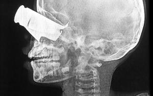 Boy with shrapnel wound