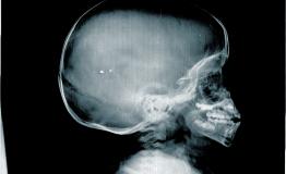 Girl Skull X-Ray
