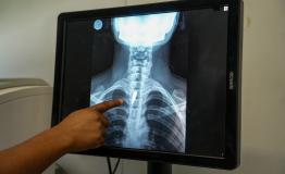 An X-ray shows a bullet lodged in the chest of Linda, 21. Surgeons determined it was too risky to remove, so she will have to continue living with it.