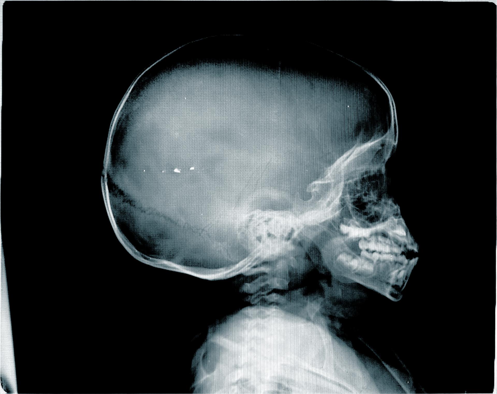 Girl Skull X-Ray