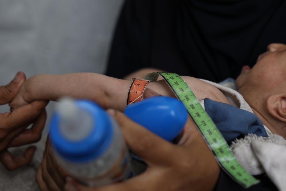 A Palestinian child who suffers from malnutrition undergos a medical checkup in MSF clinic in Gaza city.