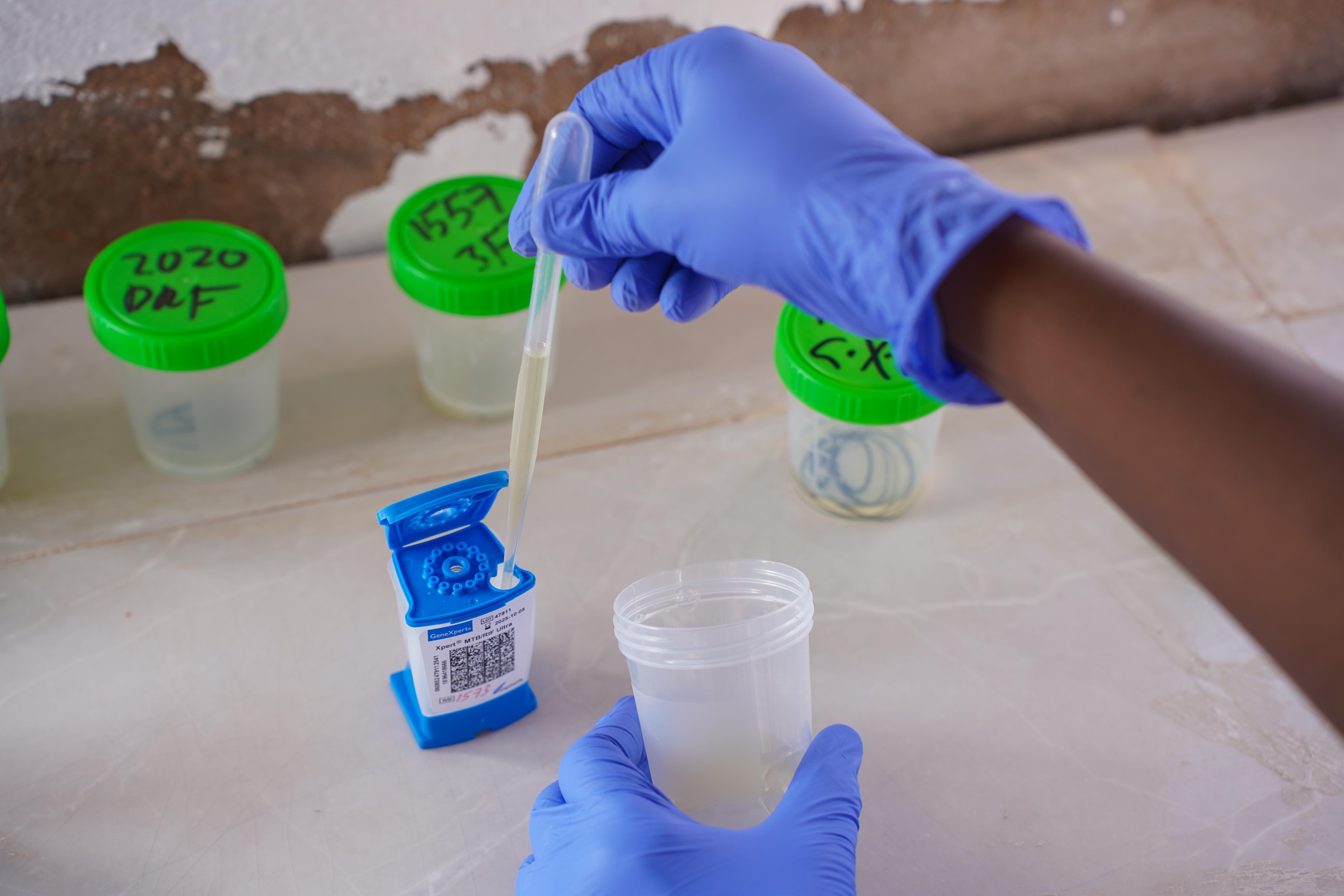 A laboratory assistant at the MSF-supported TB hospital in Galkayo North transfers sputum into a GeneXpert cartridge in preparation to carry out TB test