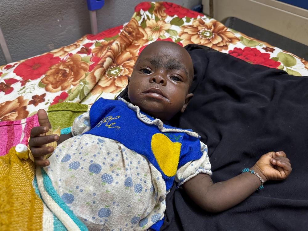 Nastrin is a 10-month-old baby who is malnourished and infected with measles—a deadly combination in a war zone. As the conflict in Darfur continues, access to healthcare and food remains extremely limited, leaving children especially vulnerable.